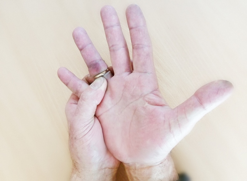 Спасатели ГКУ МО «Мособлпожспас» освободили палец молодого человека от застрявшего кольца