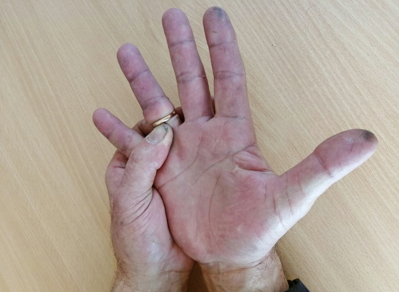 Спасатели ГКУ МО «Мособлпожспас» освободили палец мужчины от застрявшего кольца