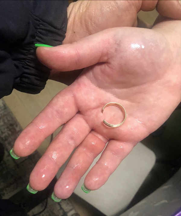 Спасатели ГКУ МО «Мособлпожспас» помогли женщине снять застрявшее на пальце кольцо